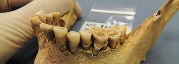 Archeologists Study Ancient Teeth To Uncover Evolution Of Disease