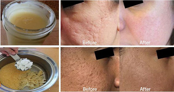 Take advantage of this cream limited to 2 weeks and say so long to old acne scar removal