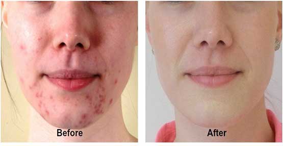 5 Simple suggestions to get Acne and pimple free smooth skin